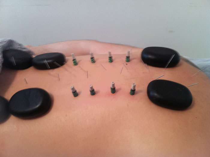 Slider-Needles-and-hot-stones